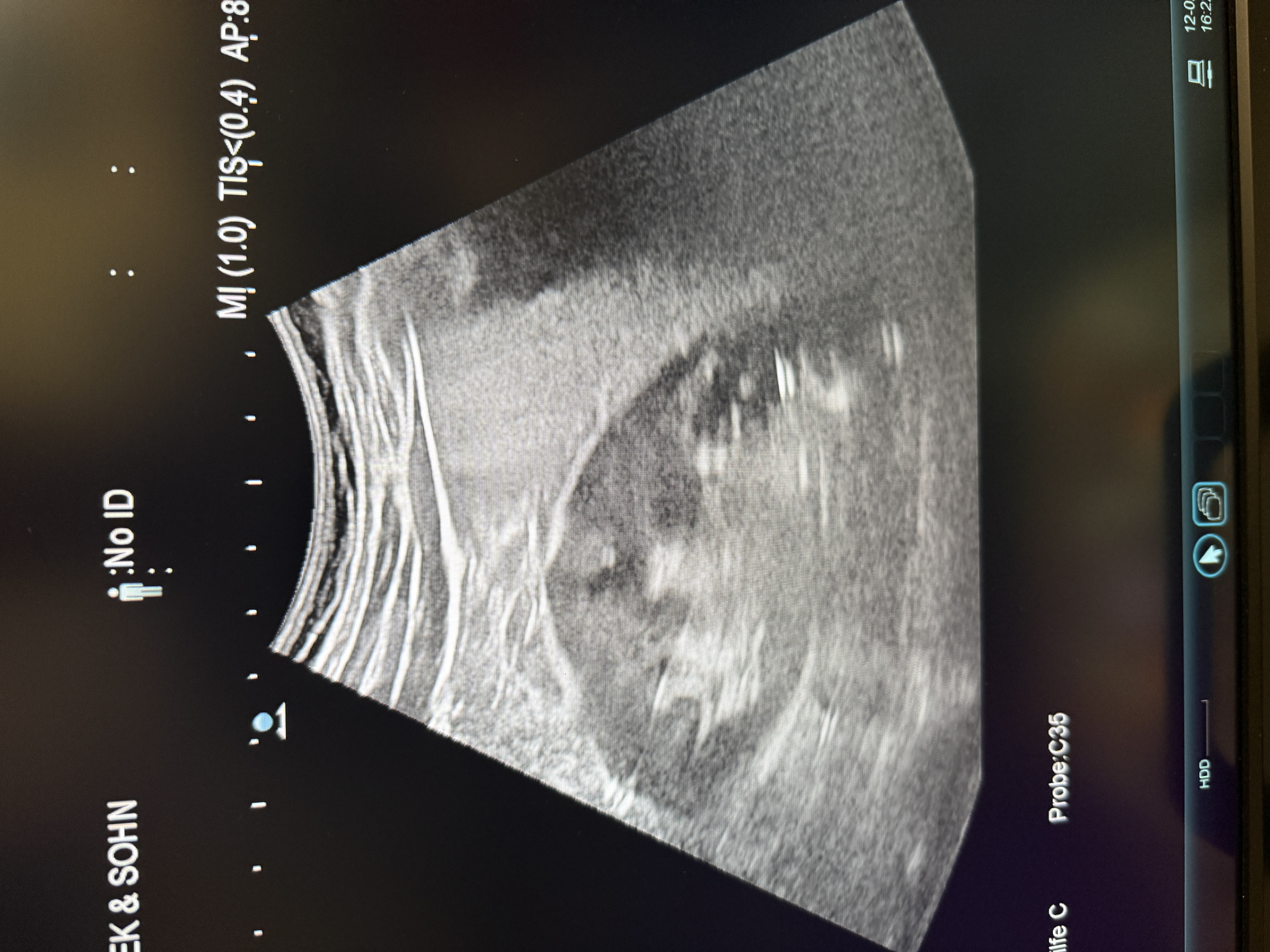 Hitachi Canon Arietta V70 Ultraschallgerät Gynäkologie – Bild 4