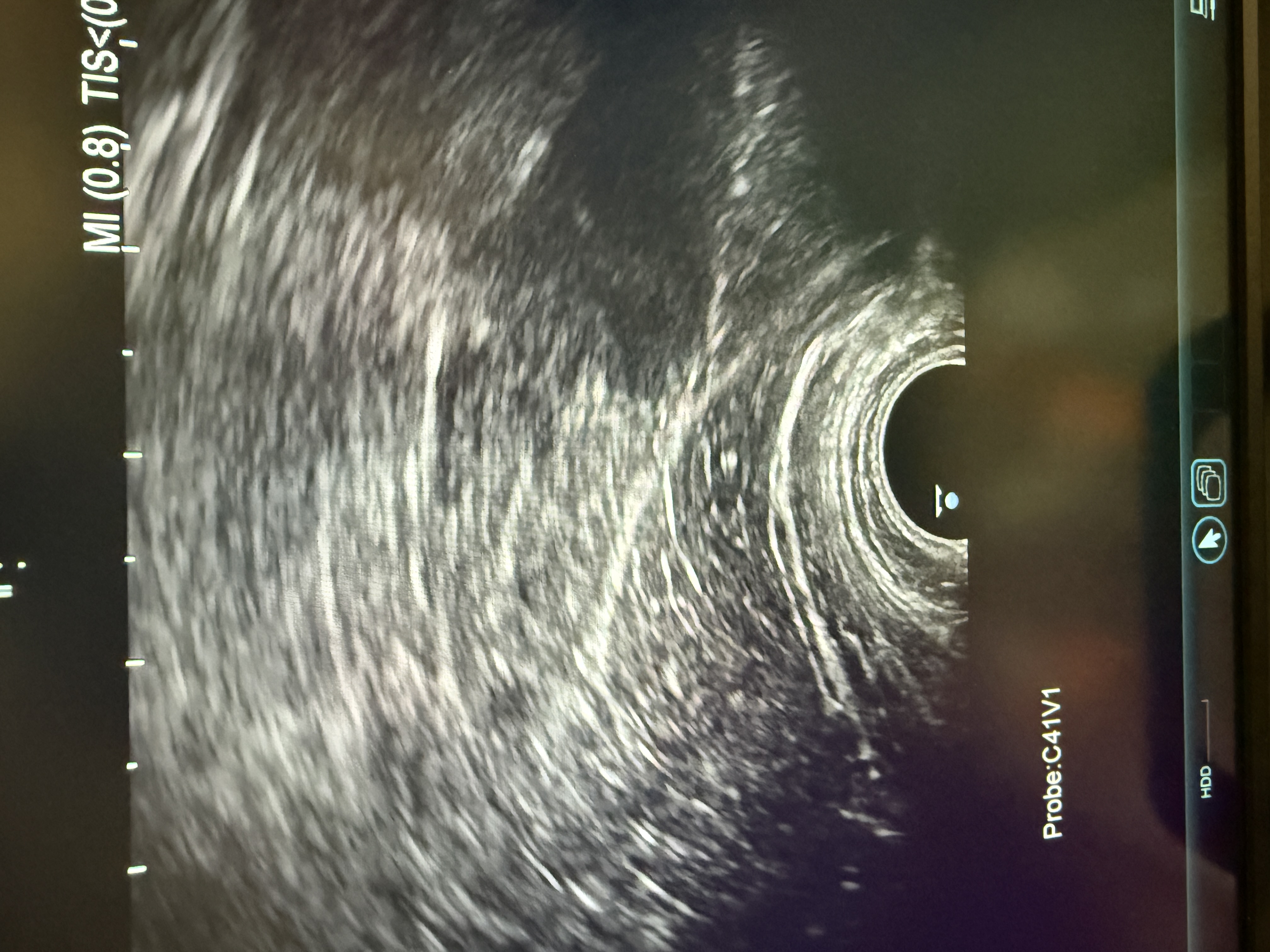 Hitachi Canon Arietta V70 Ultraschallgerät Gynäkologie – Bild 5