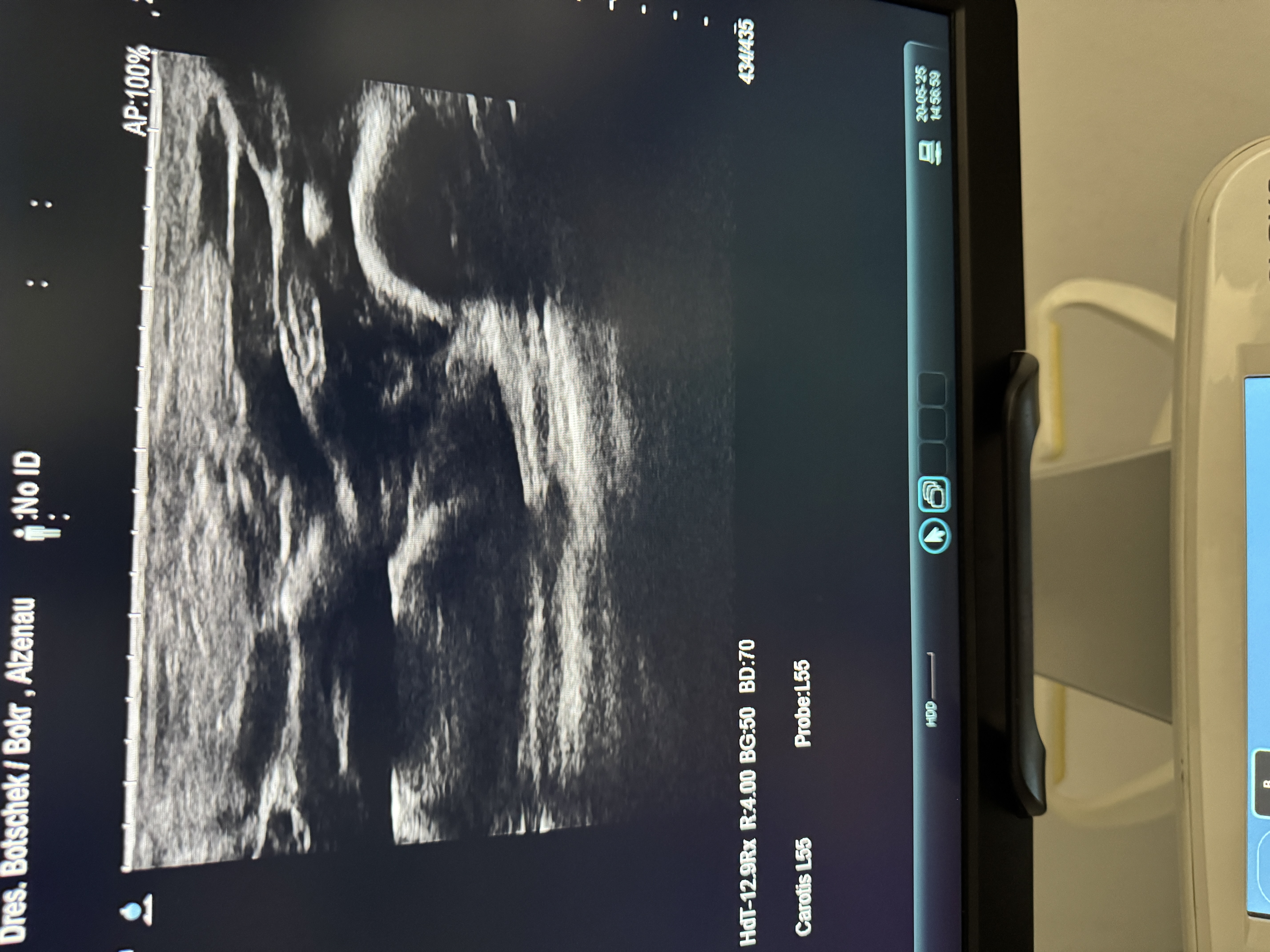 Hitachi Canon Arietta V70 Ultraschallgerät Gynäkologie – Bild 4